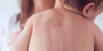 Քութեշը սեզոնային հիվանդություն է,-ասում է վարակաբանը